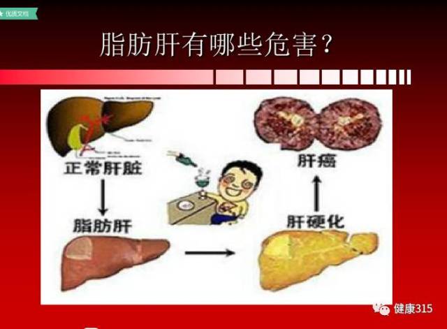 用人类iPS细胞培育的肝脏类器官可改善实验鼠肝纤维化