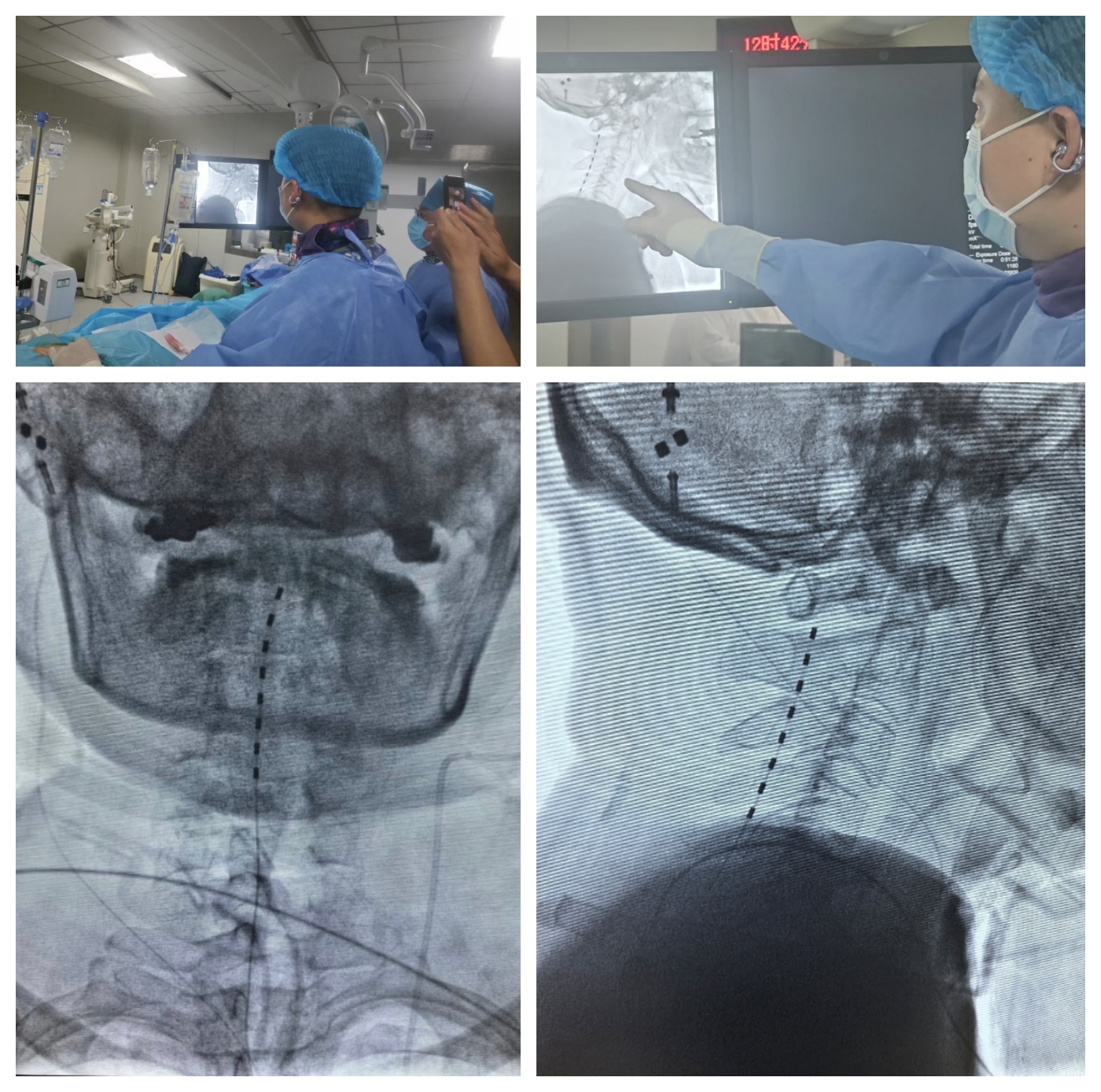 西部首例！脊髓损伤患者脑机接口手术于四川大学华西医院顺利完成