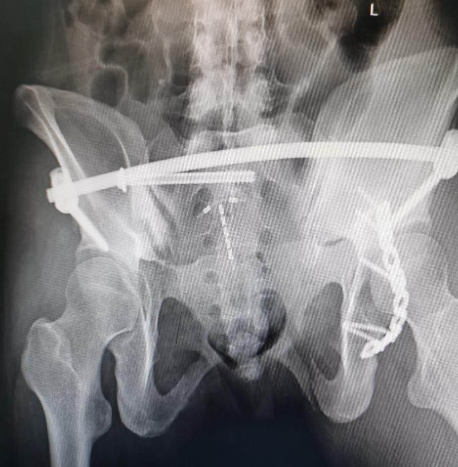 宜安科技：镁骨内固定螺钉注册正按要求推进