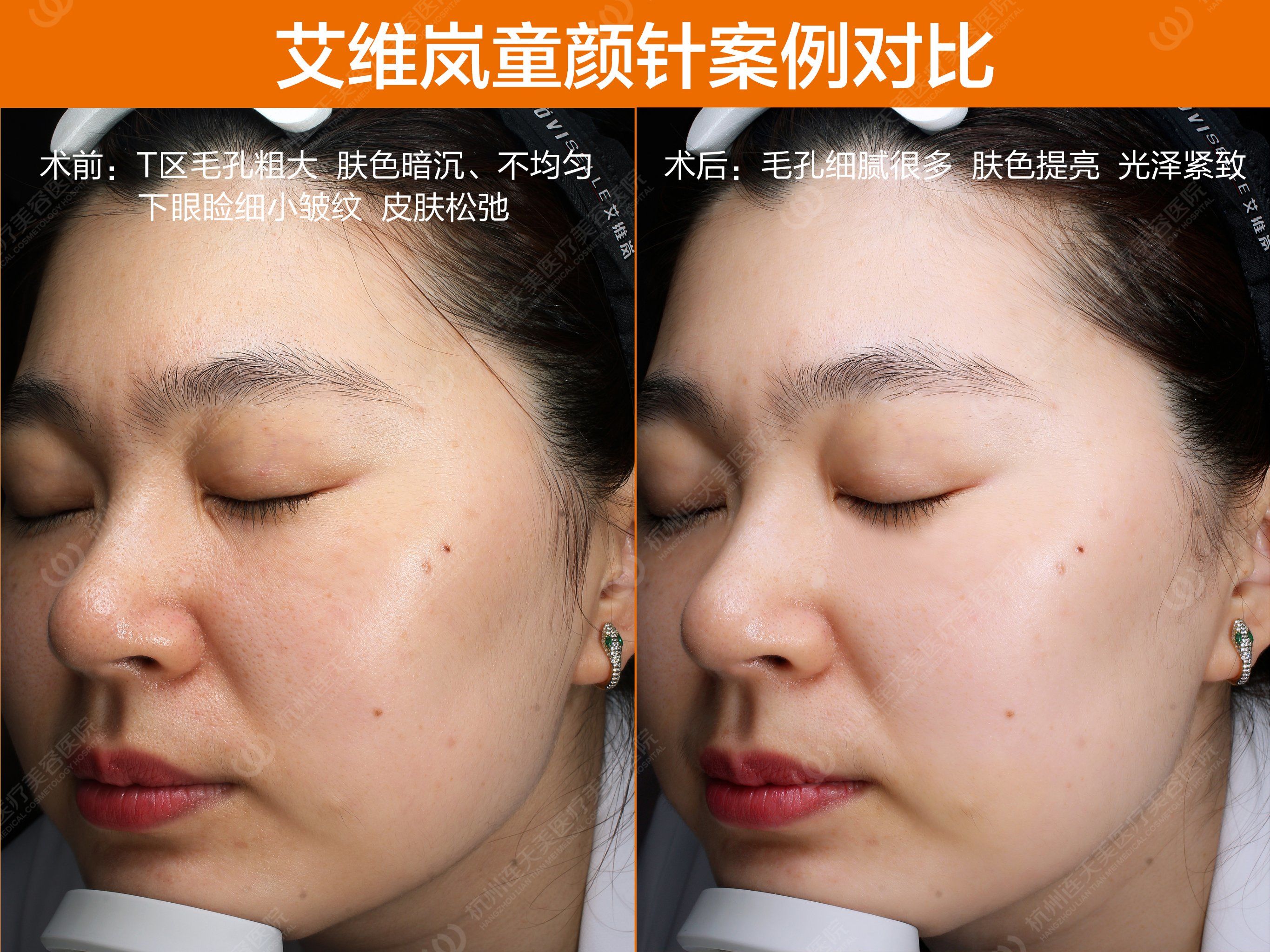 从1.8万降到2899元,艾维岚躬身入局“童颜针大战”